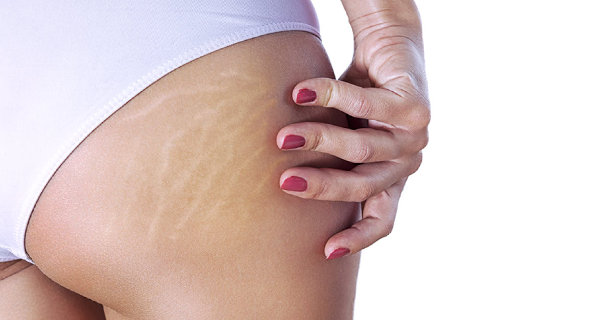 Mesoterapia Corporal para Estrías y Cicatrices ¿Realmente Funciona